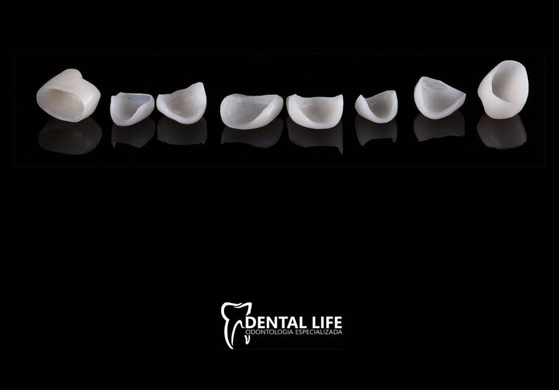 Tratamento com facetas em porcelana em Curitiba.