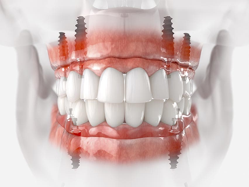 Planejamento de protocolo odontologico em Curitiba.